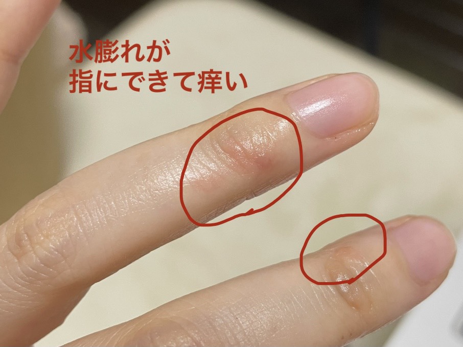 手のニキビは潰したほうがいいですか?